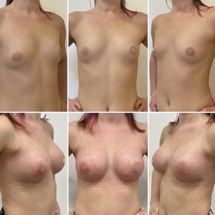 Увеличение груди анатомическими имплантатами