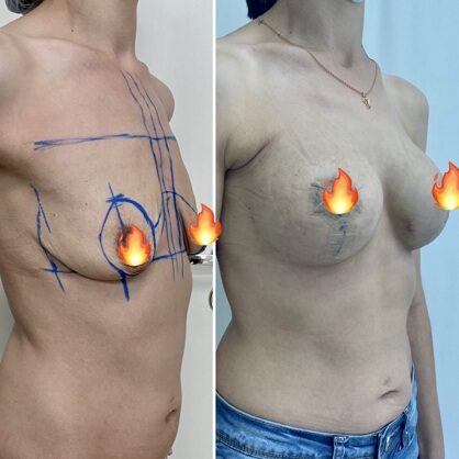 Подтяжка груди с имплантатами